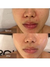 マインエム(mine.m)/刺さないリジュランアンプル