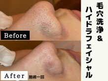 シャルムクリニカルサロン 池袋(Charme clinical salon)/毛穴洗浄＆ハイドラフェイシャル