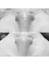 カシェット(cachette)/イチゴ鼻もすっきり