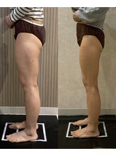 OBS新潟整骨院/新潟初脂肪冷却PRO　下半身痩せ