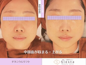シエスタ(siesta)/チタニウムリフト【小顔・毛穴】