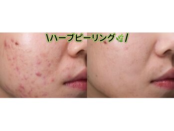 ルミナエステ(LUMINA ESTH)/ハーブピーリング/川口