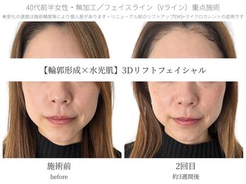 サボラミ(sabor A Mi)/短期集中施術でより効果出し◎