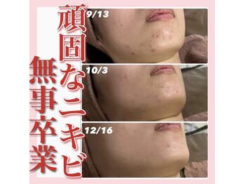 アルムダアクア 天王寺店(Aleumda AQUA)/ハーブピーリング/大阪/天王寺