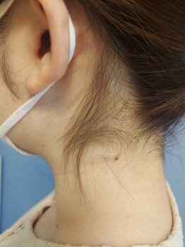 キアラ 麻布十番(Kiara)/うなじえりあし脱毛　