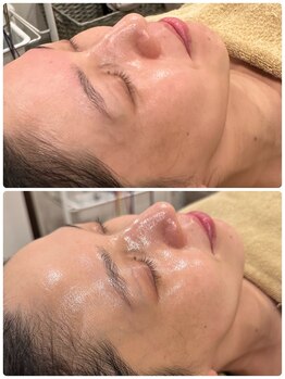 ユララ(YURARA)/角質ケアで肌質改善♪