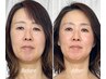 【顔の長さ/小顔】美骨形成術×美容整体　おでこ/中顔面/人中/アゴ短縮
