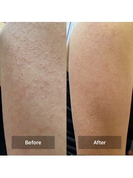 モカ 天王寺店(MOKA)/剥離◯3回目 毛穴 プツプツ