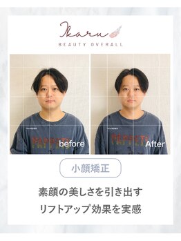イカル 池袋(ikaru)/小顔矯正 before after 