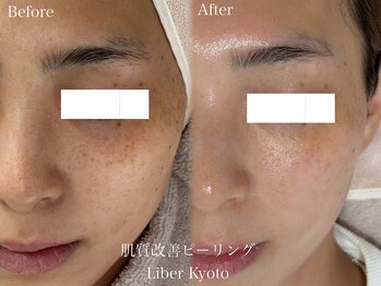 エステティック リベル キョウト 京都駅前店(Esthetic Liber Kyoto)/肌質改善ピーリング