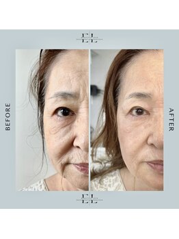 ホワイトラボ 姫路(White labo)の写真/医師監修の臍帯幹細胞培養上清液で究極のエイジングケアが叶う♪やればやるほどに効果実感◎