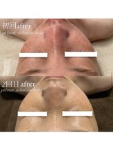 カシェット(cachette)/赤みの改善にも