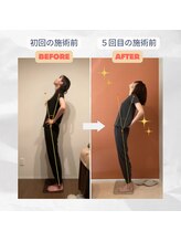 ラクリエ 姫路駅前院(La Creer)/後屈可動域ビフォーアフター