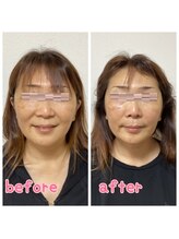 小顔整体 優/顎が尖りスッキリフェイスライン