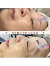 ルルーディア(LOULOUDIA)/シミケアで輝くお肌へ♪