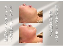 アールメディカルサロン 富山院(R Medical Salon)の雰囲気（サーマクールと脂肪燃焼で顎下フェイスラインもたつき解消！）