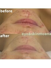 モアナ(moana)/ララピール