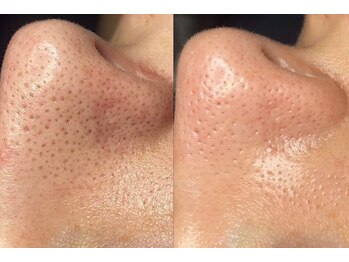 ルミナエステ(LUMINA ESTH)/毛穴/毛穴洗浄/毛穴ケア|症例