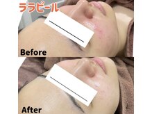 アリュールビューティー 下高井戸店(ALLURE BEAUTY)/モニター様紹介★