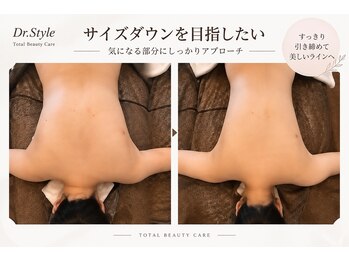 ドクタースタイル(Dr.style)の写真/ 最新型上位機種ハイパーナイフEX2認定店☆皮下脂肪層にアプローチし/内臓脂肪まで分解/サイズダウン実感