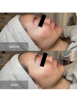 ワクワクフェイス 横浜店(WAKUWAKU FACE)/新世代ハーブピーリング/横浜