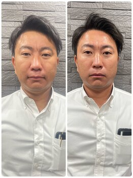 長寿鍼灸院 長寿整骨院/men's美容鍼50本効果★