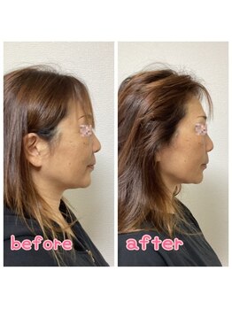 小顔整体 優/横顔美人へ！顎が尖ります