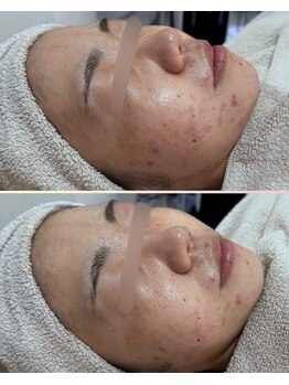 ソワナ(soina)/【神楽坂駅/フェイシャル/毛穴】