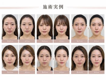 小顔矯正プロの写真/【疲れた目元をパッと明るく】たるみやしわ、シミを根本改善＆予防◎ハリと透明感溢れる若々しい印象へ