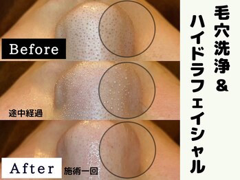 シャルムクリニカルサロン 池袋(Charme clinical salon)/毛穴洗浄＆ハイドラフェイシャル