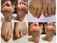 ビサンテ サロン/角質ケア＆自爪ケアで素足綺麗