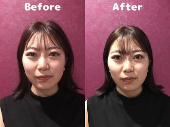 くにたちNyan鍼灸整体院/【小顔矯正】Before After 1