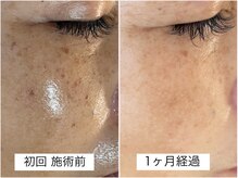サロン マリー(SALON MARIE)/最新光フェイシャル１回目の変化