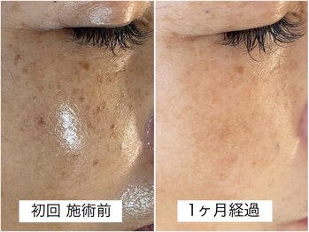 サロン マリー(SALON MARIE)/最新光フェイシャル１回目の変化