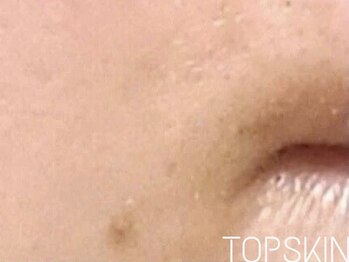 トップスキン 名駅(TOPSKIN)/TCLINEシミ改善の効果
