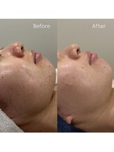 ウィール 栄 矢場町店(WE:LL)/ハーブピーリング