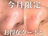 【8月限定】夏の毛穴対策！毛穴開き・黒ずみフェイシャル￥19800→￥11000