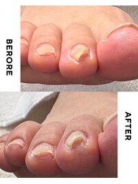 【美爪育成】《フット》巻き爪