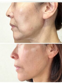 仙豆のちから 自由が丘店/テラボーラー1回の変化