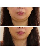 デイスパ ヴィータ/before &nbsp;&nbsp;after