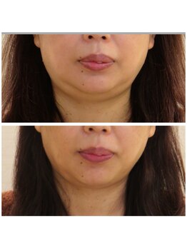 デイスパ ヴィータ/before after