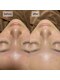ヒナノボディ(HINANO BODY)の写真/【ハイドラ毛穴洗浄】で、普段のクレンジングでは落としきれない毛穴汚れや古い角質をすっきりケア◎