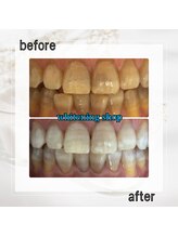 ホワイトニングショップ 亀戸店/【亀戸】美白ホワイトニング