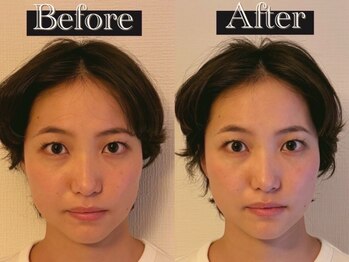 リズボディ(RizBody)/【Before After】施術1回目