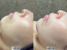 アンドミー 福岡博多店(&me)/ララピール【艶肌/美白/くすみ】