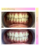 エクシアホワイトニング 奥田店/ホワイトニングビフォーアフター
