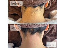 人気のWax脱毛★その日にツルツルに♪うねじ/わき/VIO可能！