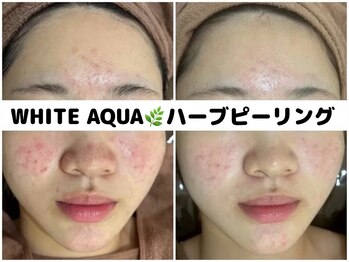 ホワイトアクア 柏店(WHITE AQUA)/ハーブピーリング/ニキビケア