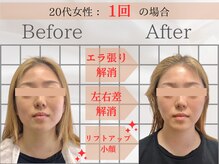 ヴィズクラブ バイ ビネル(Vi's CLUB by BINEL)/フェイシャルbefore/after