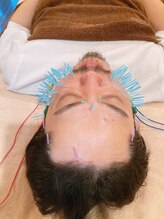 アキュティ 吉祥寺(Acuty)/電気を流す小顔美容鍼100本